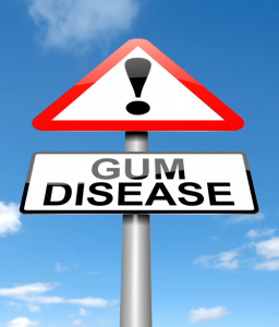 Gum-Disease-Silent