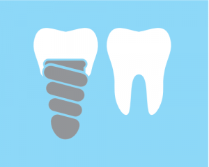 dental implant