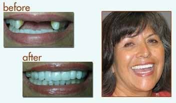 Before and after of woman with front teeth dental implants