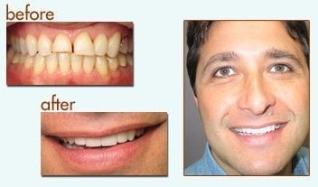 man smiling with new porcelain vene