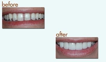 Before and after of teeth straightening