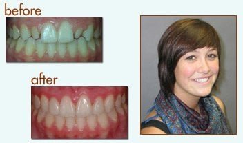 before after dental photos at Ventura Center for Dental Health