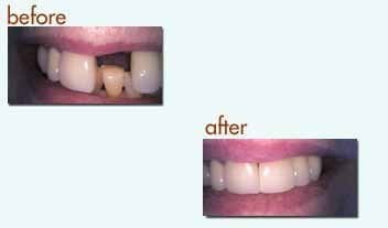 Before and After: closeup of a dental implant