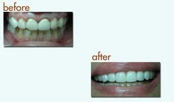 before after dental photos at Ventura Center for Dental Health