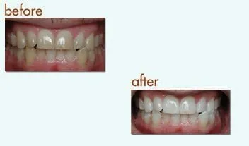 Before and after of at home teeth whitening