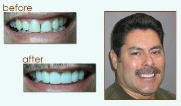 Happy Dental Customer smiling with his new straight teeth
