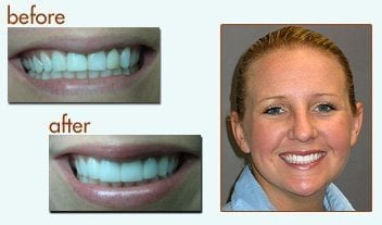 Woman smiling with new porcelain veneers