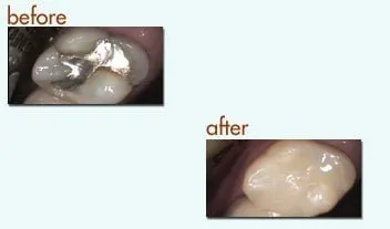 Before and After: amalgam filling to non metal filling