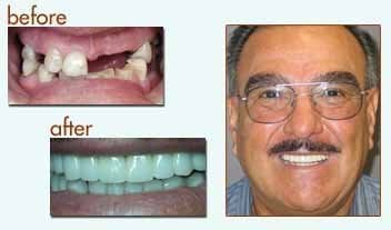 Before and After of a man with a complete smile makeover