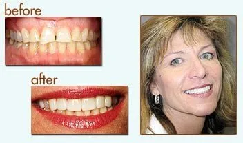 Before and After of a woman with new teeth