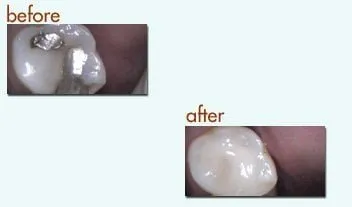 Before and After: metal filling to non metal filling