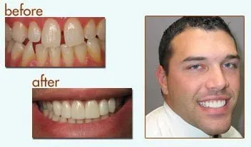 Before and After of a man with new porcelain veneers
