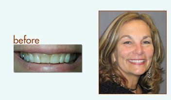Before and After of a woman with porcelain veneers