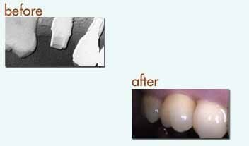 Before and After: closeup of a dental implant xray