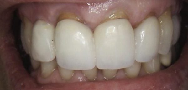 Smile makeovers